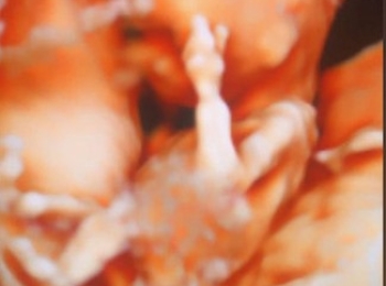 الموجات فوق الصوتية للحامل وتشوهات الجنين