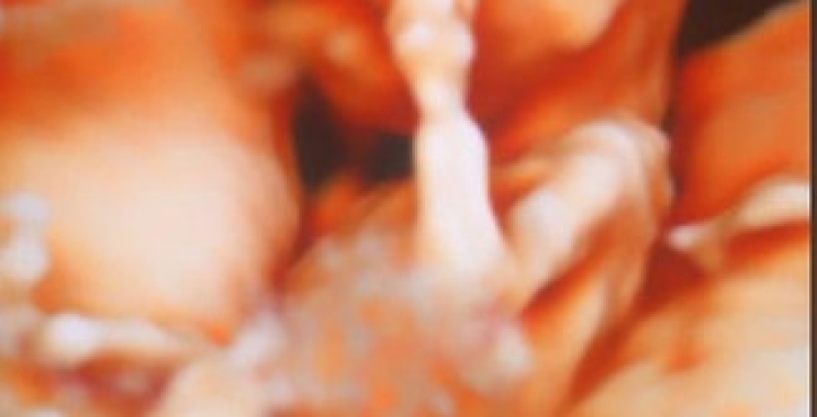 الموجات فوق الصوتية للحامل وتشوهات الجنين