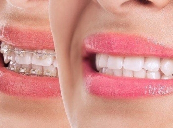 الفرق بين شكل الفك الطبيعي قبل وبعد التقويم والحصول على ابتسامة ساحرة
