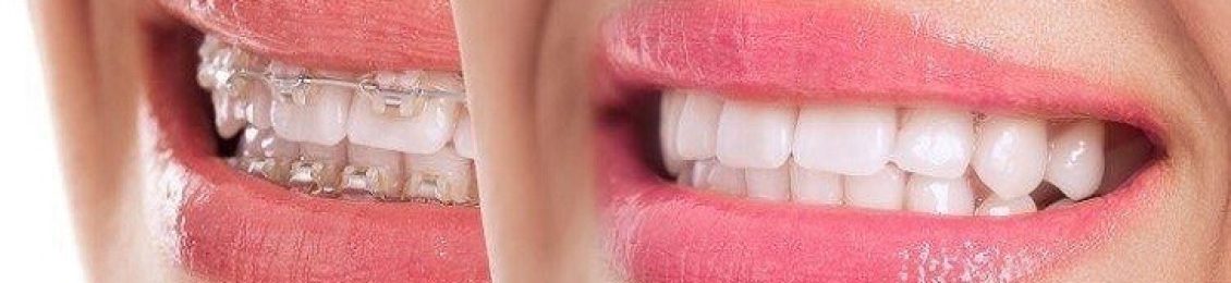 الفرق بين شكل الفك الطبيعي قبل وبعد التقويم والحصول على ابتسامة ساحرة