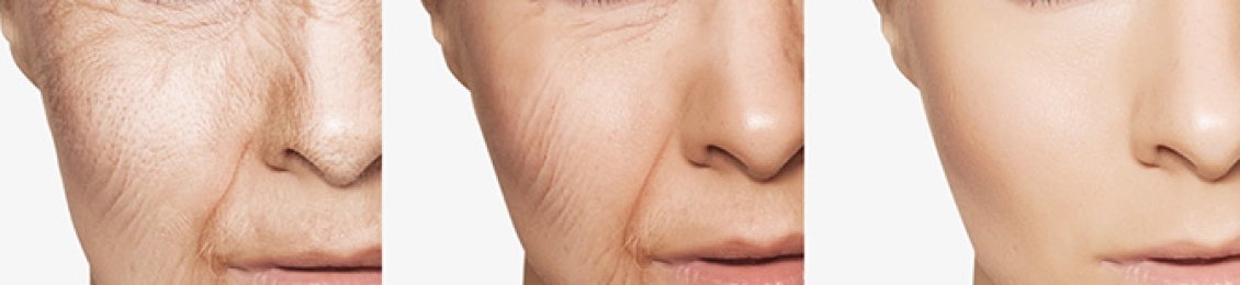 ما هي خطوات البوتكس للوجه مع أفضل الاطباء؟