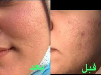 فراكشنال ليزر في علاج آثار حب الشباب: هل تستحق التجربة؟