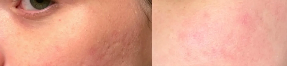 فراكشنال ليزر للتصبغات: الحل الأمثل لبشرة صافية