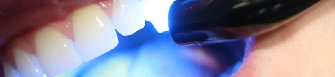 حشو ليزر للضرس التقنية الحديثة لعلاج التسوس بدقة وأمان
