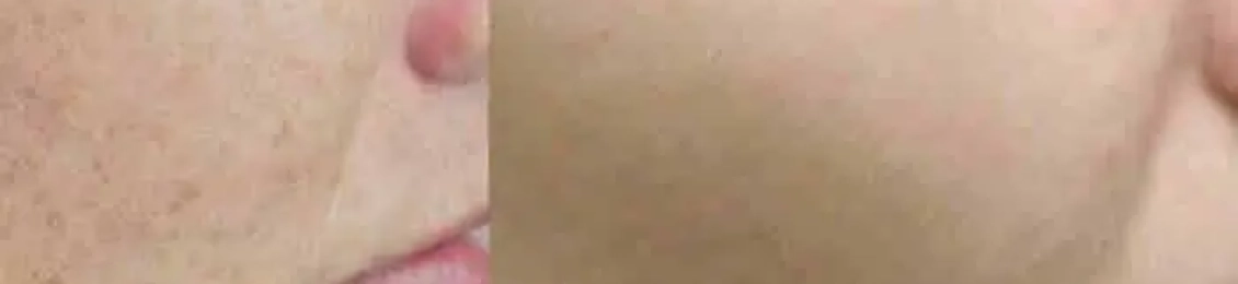 فراكشنال ليزر للندبات علاج فعال لآثار حب الشباب والجروح