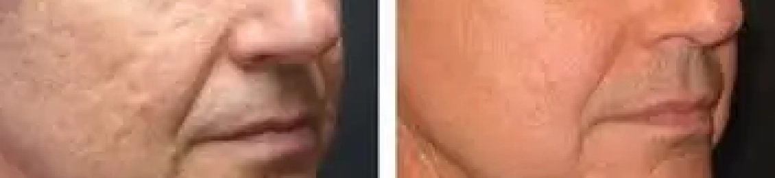 فراكشنال ليزر للوجه تجربتي تعرف عليها