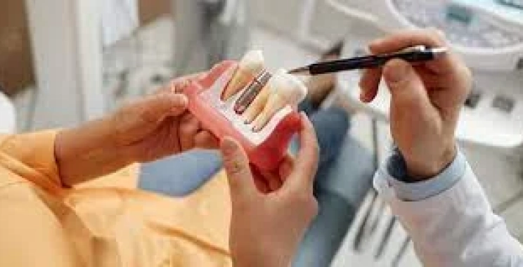 أهم اعراض ما بعد زراعة الأسنان وكيفية التعامل معها بذكاء