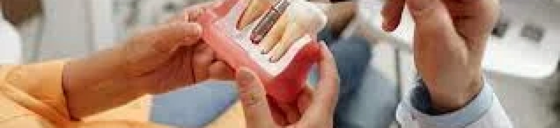 أهم اعراض ما بعد زراعة الأسنان وكيفية التعامل معها بذكاء