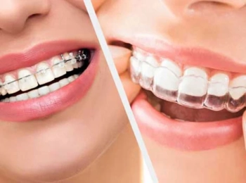 كم مدة مثبت الأسنان بعد التقويم؟ دليل شامل للحفاظ على نتائجك