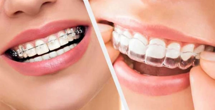 كم مدة مثبت الأسنان بعد التقويم؟ دليل شامل للحفاظ على نتائجك