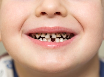 د.رامي نفاخ: افضل دكتور علاج اسنان مسوسة اطفال