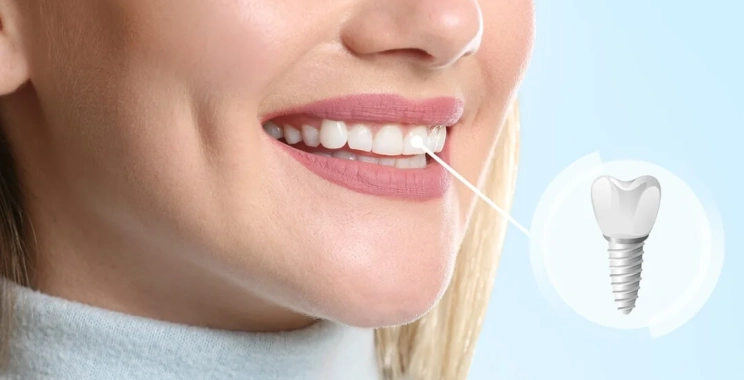 تجربتي مع زراعة الأسنان: الخطوات والنتائج