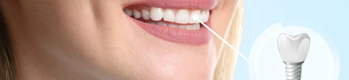 تجربتي مع زراعة الأسنان: الخطوات والنتائج