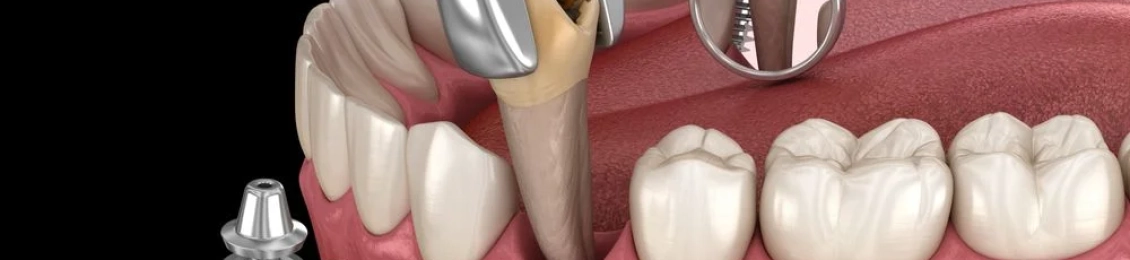 تجربتي مع زراعة عظم الفك: تفاصيل من داخل غرفة العمليات