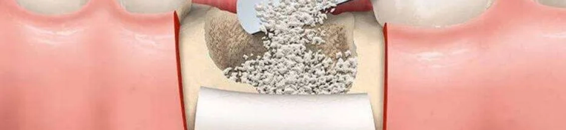 تجربتي مع زراعة عظم الفك السفلي: خطوات العملية والألم والنتائج بعد الشفاء