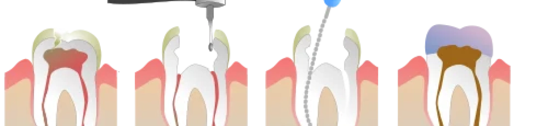 تجربتي مع علاج عصب الأسنان: من الألم إلى الراحة