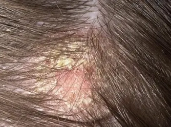 نصائح من تجربتي مع فطريات الشعر والعلاج الفعال