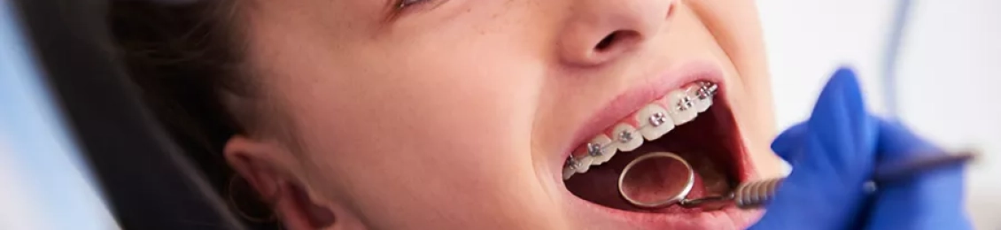 حجز موعد تقويم أسنان للأطفال لتحسين صحة الأسنان مبكراً