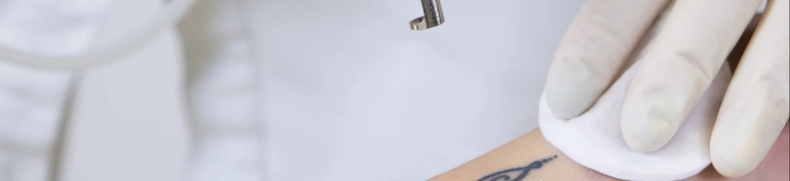 أفضل نتائج ليزر إزالة الوشم المدينة المنورة