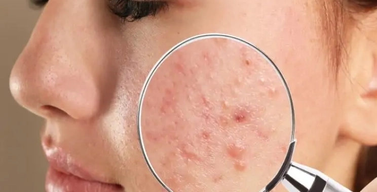 علاج ندبات حب الشباب: أحدث الطرق الطبية لاستعادة صفاء البشرة