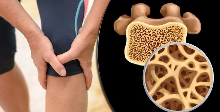 أسباب هشاشة العظام وعوامل الخطر