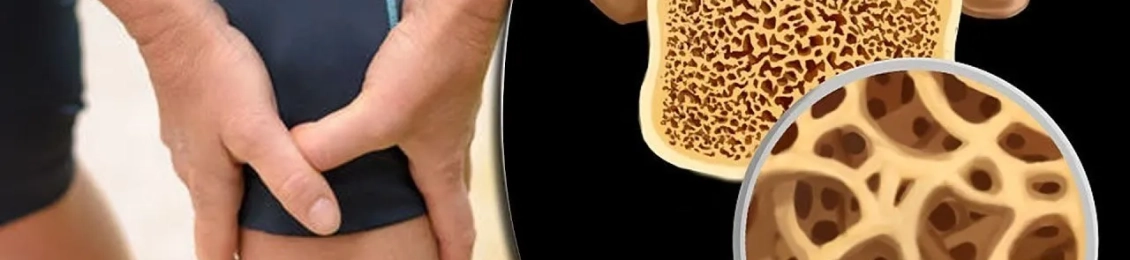 أسباب هشاشة العظام وعوامل الخطر