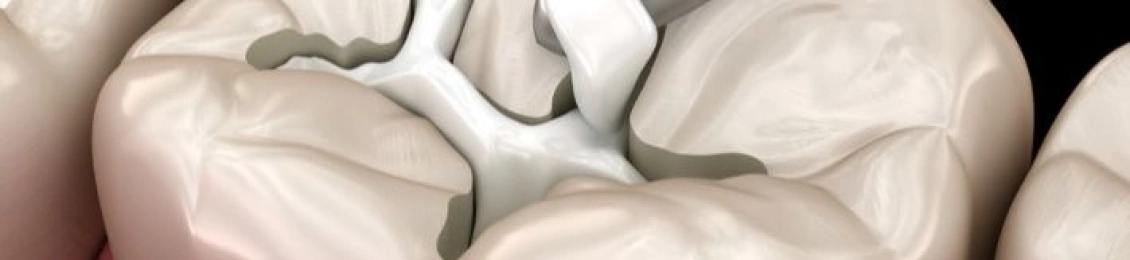 ما هو أفضل نوع حشو للأسنان؟ التجميلي أم البلاتيني