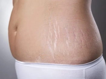 ما هو الفرق بين علامات التمدد البيضاء والحمراء