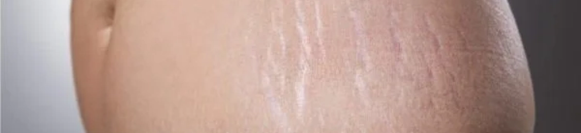 ما هو الفرق بين علامات التمدد البيضاء والحمراء