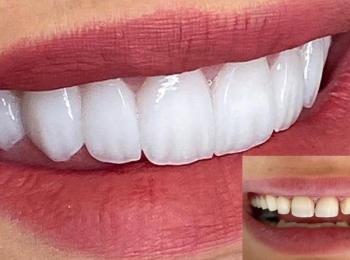 ابتسامة هوليود 3D تعرف على فوائدها وأهميتها وسعرها