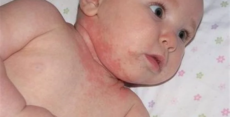 ما هي أسباب حساسية الجلد عند الأطفال وكيف يمكن تجنبها