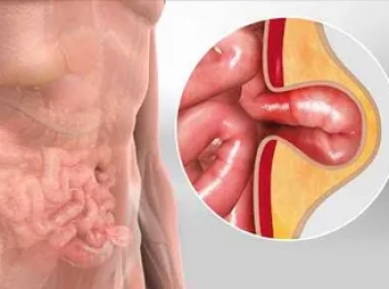 افضل دكتور اشعه سونار على الفتق السري وما هي اعراضه