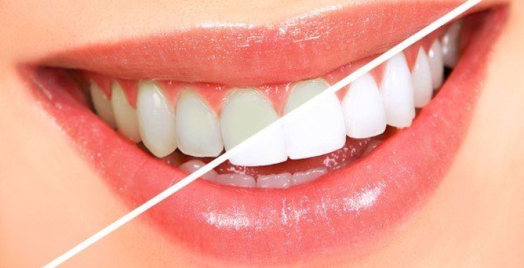 تنظيف وتلميع الاسنان ما هي التكلفة المتوقعة وأهميته للعناية بصحة الفم