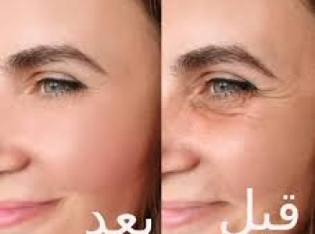 هل الوجه يرجع طبيعي بعد البوتكس؟ تعرفي على الإجابة
