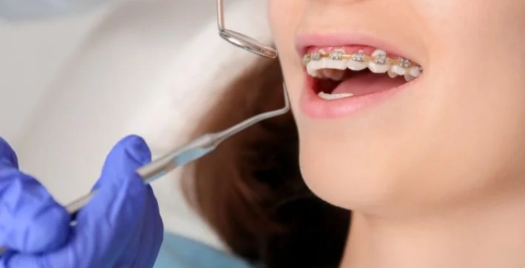 كم يستغرق تركيب التقويم عند الدكتور؟ خطوات الإجراء والزمن التقريبي