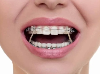 كيف يشدون تقويم الأسنان؟ ولماذا؟