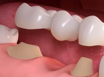 افضل دكتورة تركيبات اسنان وانواعها في المدينة المنورة