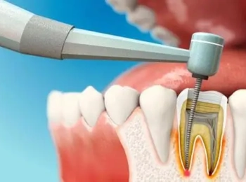 كيف هو ميكروسكوب علاج العصب وطريقة العلاج به؟