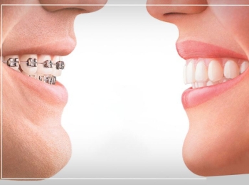 الفرق بين تقويم الأسنان الشفاف الانفزلاين وتقويم الأسنان العادي