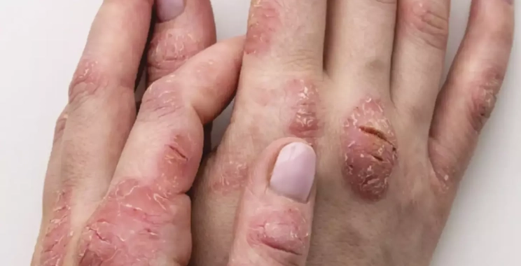 ما هي أنواع الأكزيما بالصور وعلاجها