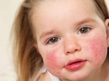 هل حساسية الطعام خطيرة للاطفال وما هي مضاعفاتها؟