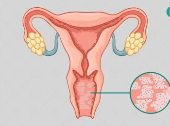 اعراض الالتهاب البكتيري للمهبل في الصيف وعلاجها