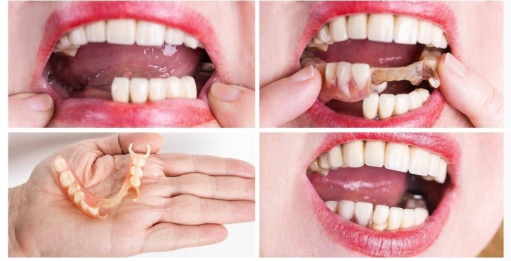 افضل تركيبات الاسنان الامامية داخل مجمع الطب المتميز