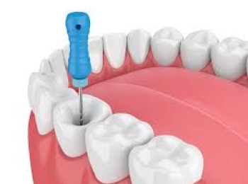 استعادة الصحة الكاملة لأسنانك مع افضل دكتور علاج عصب الأسنان بالمدينة المنورة 