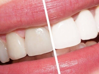 تبييض الأسنان بالليزر كم يدوم لأسنان بيضاء خالية من التصبغات