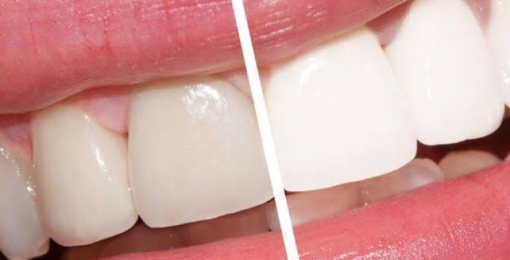 تبييض الأسنان بالليزر كم يدوم لأسنان بيضاء خالية من التصبغات