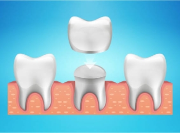 نصائح بعد تركيبات الاسنان وكيف تتم في مجمع الطب المتميز