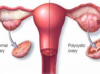افضل دكتور علاج تكيس المبايض و استئصالها جراحيا