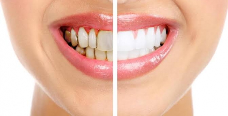 أفضل طرق تبييض الأسنان الحديثة ومميزاتها