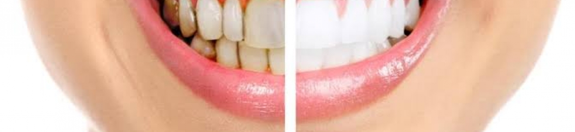 أفضل طرق تبييض الأسنان الحديثة ومميزاتها